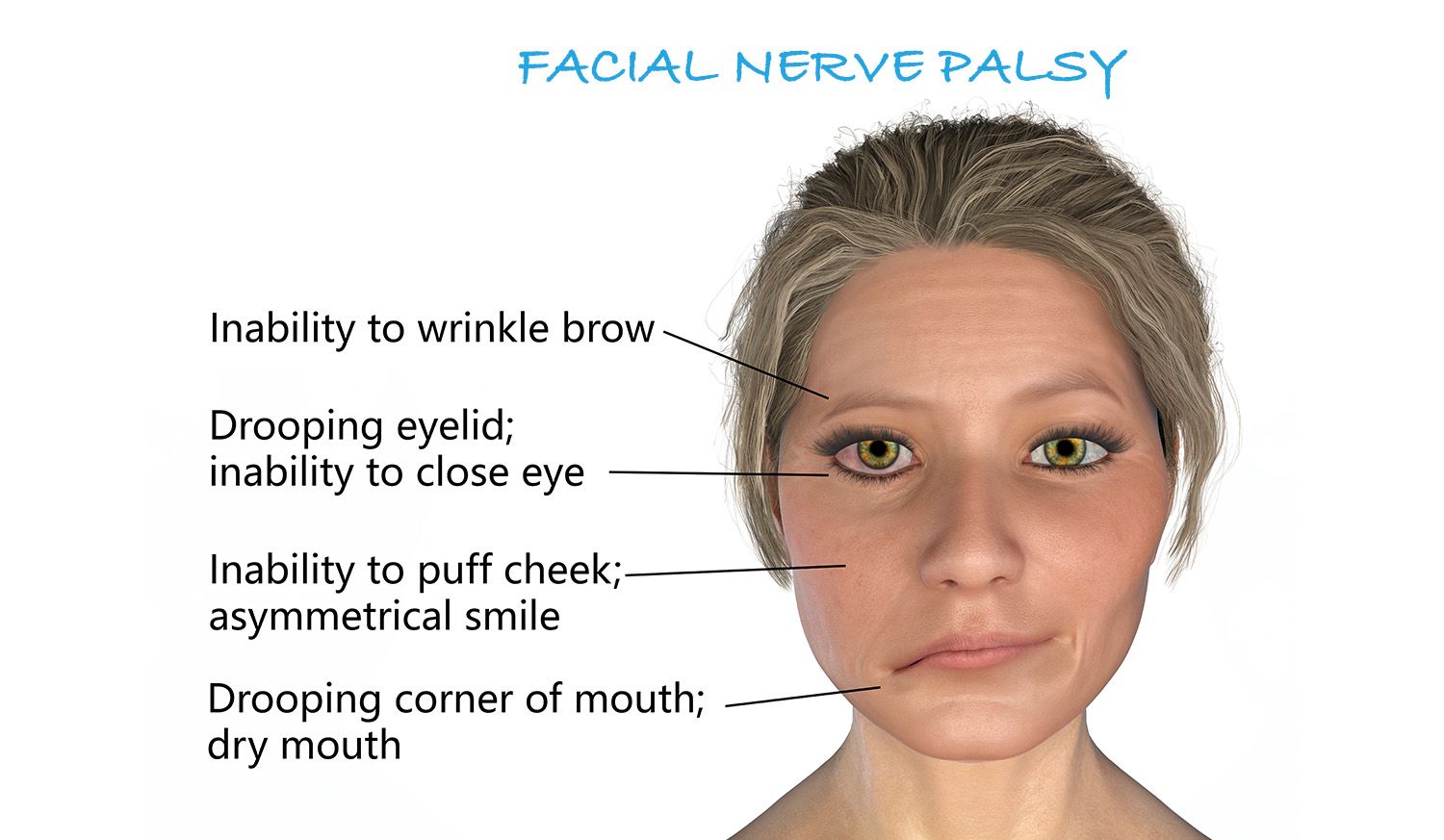 facial-paralysis