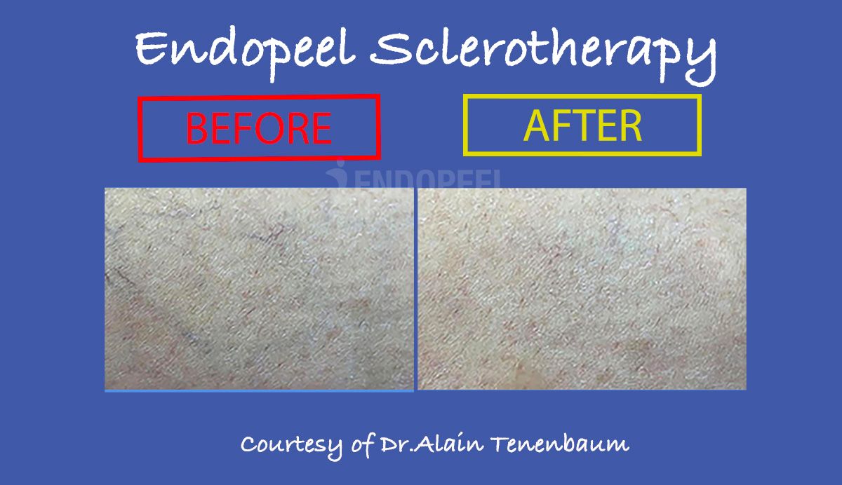 sclerotherapy-endopeel