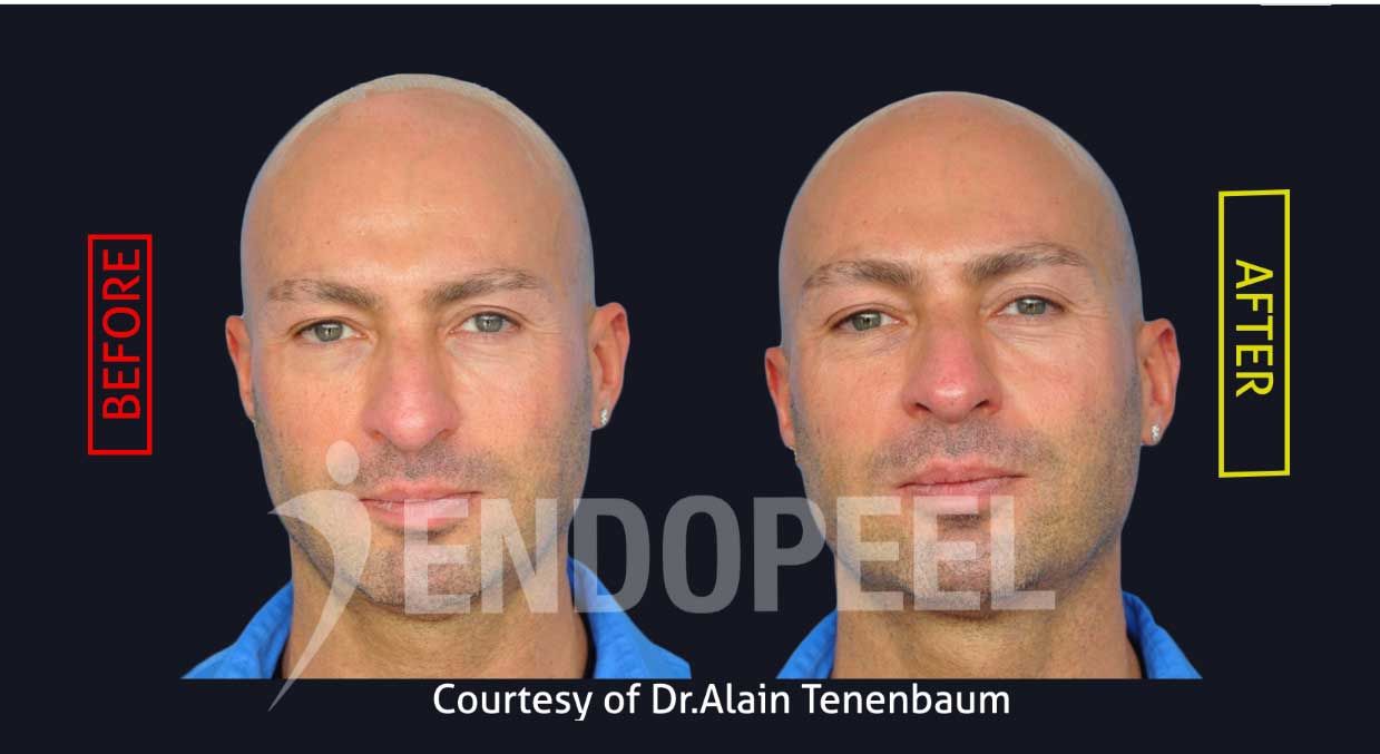 medical rhinoplasty