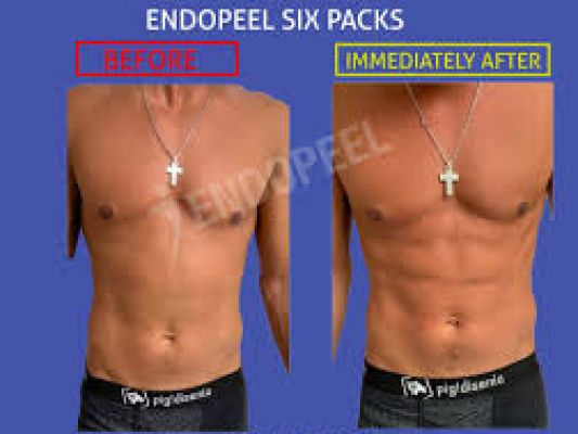 endopeel 6 packs