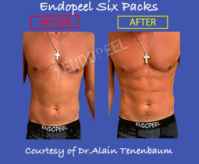 body endopeel