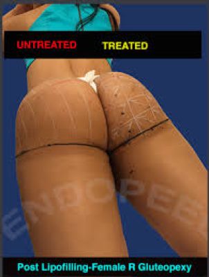 endopeel butts female post lipoplasty