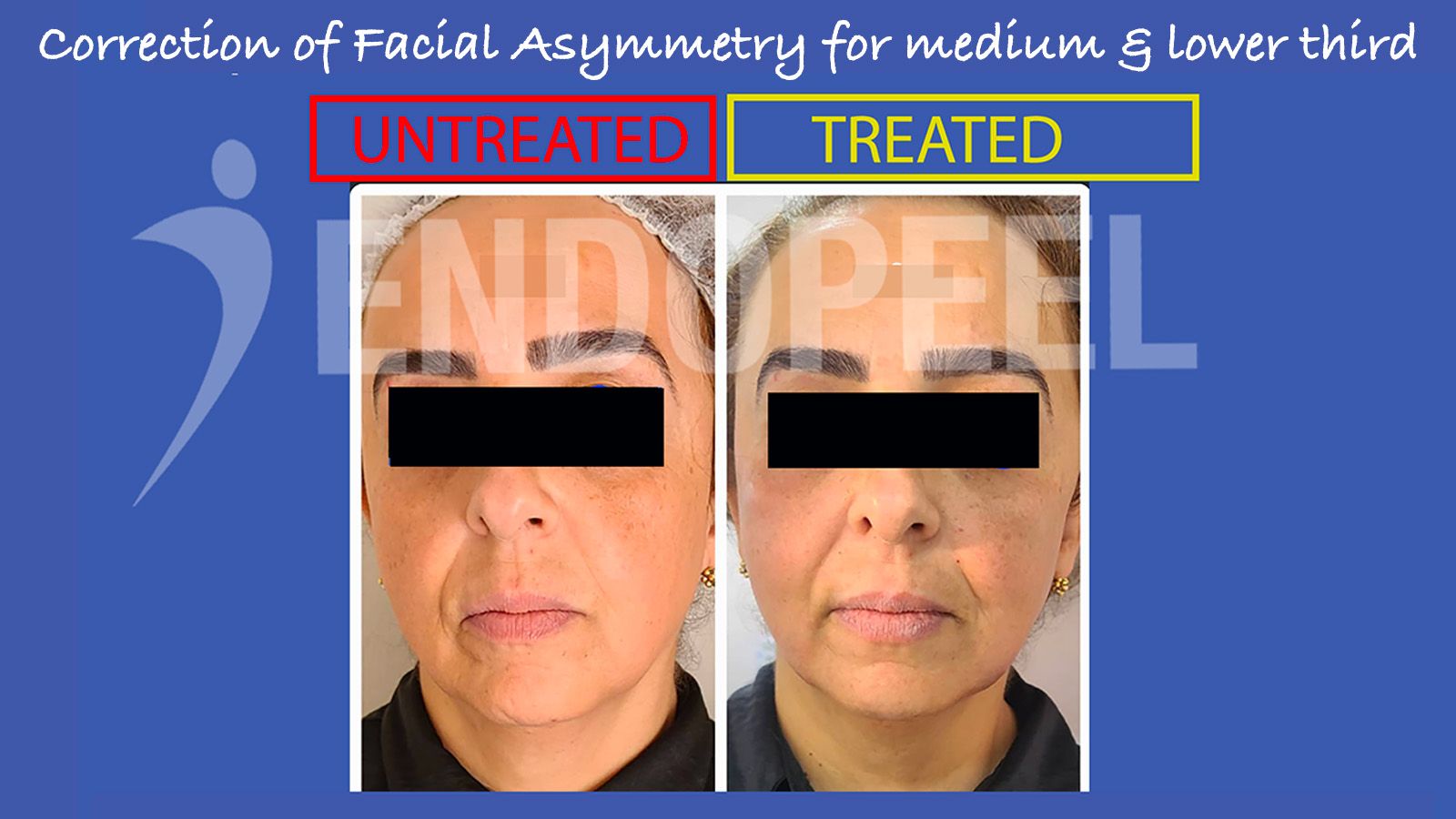 facial-asymmetry