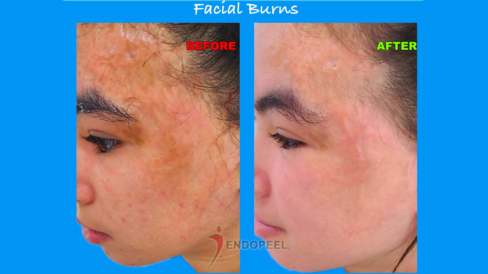 facial-burns