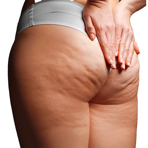 cellulite-butts