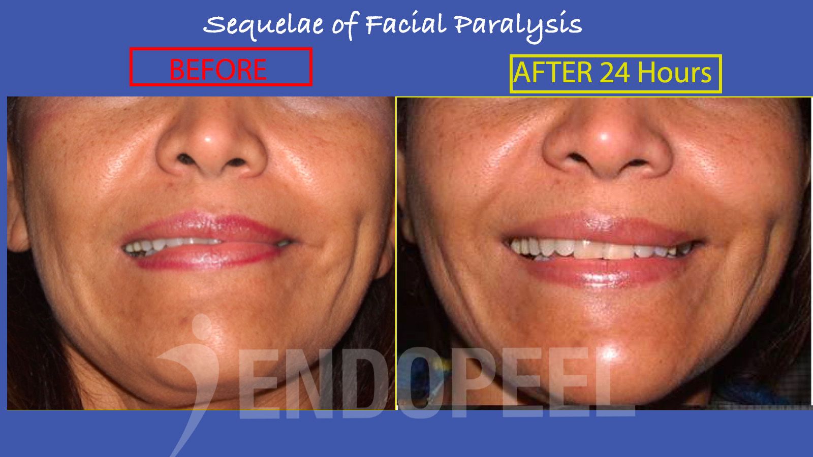 facial-paralysis-sequelae-endopeel.jpg