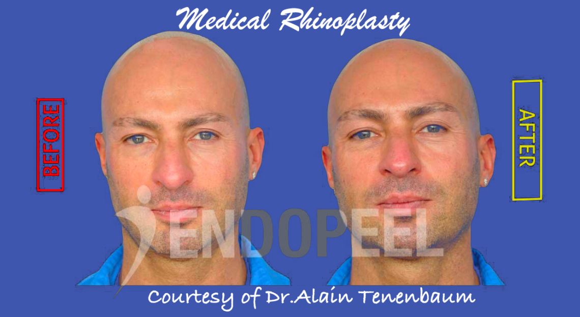 medical rhinoplasty