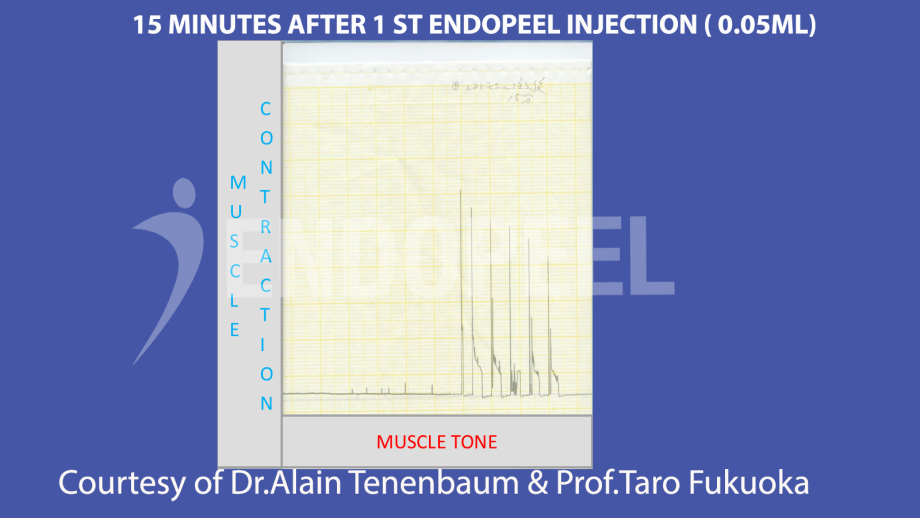 15 min after 1 st endopeel injection of 0.05 ml