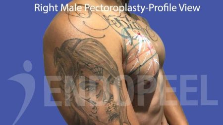 right male pectoroplasty endopeel